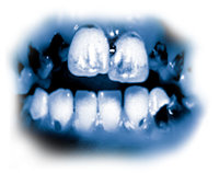 覚せい剤に含まれる有毒な化学物質は、ひどい虫歯を招きます。歯が黒く汚れて腐り出し、抜くしかない状態になることがしばしばです。歯と歯茎が内部から破壊され、歯根が腐って再生不能な状態になります。この写真のような状態の歯は、覚せい剤常用者によく見られるものです。